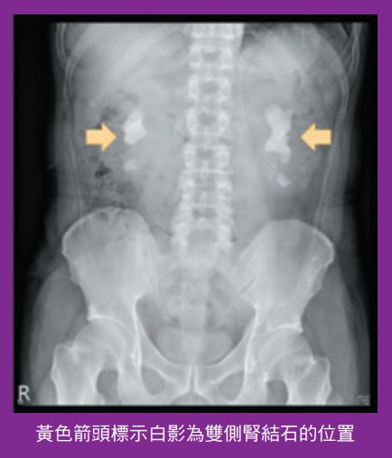  黃色箭頭標示白影為雙側腎結石的位置