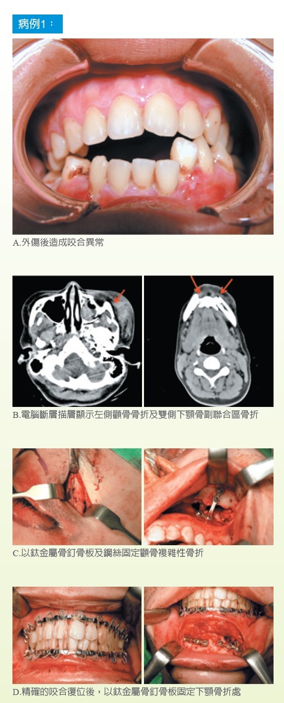 臉撞歪了怎麼辦 醫療新聞 中國醫藥大學附設醫院 臉撞歪了怎麼辦 醫療新聞 中國醫藥大學附設醫院