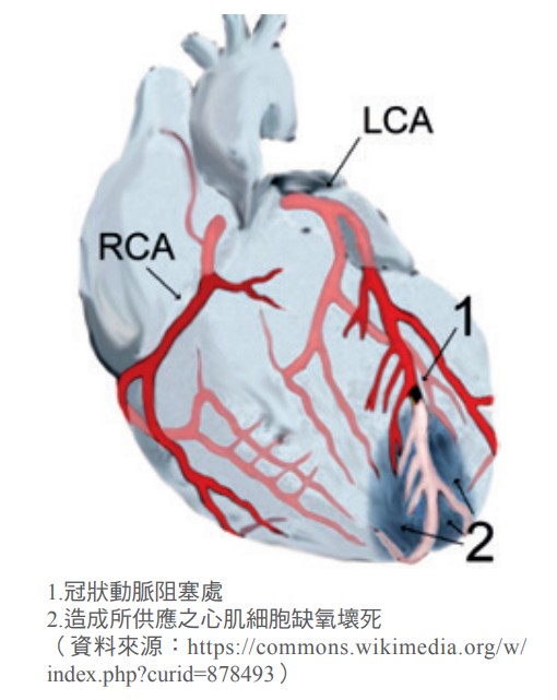 冠狀動脈阻塞處