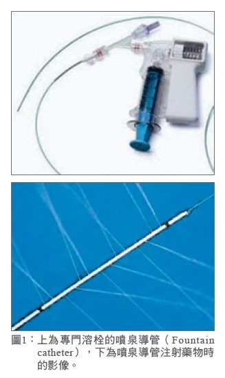圖1：上為專門溶栓的噴泉導管（Fountain catheter），下為噴泉導管注射藥物時的影像。