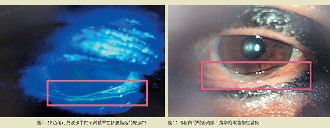 圖1： 染色後可見淚水中的染劑積聚在多層鬆弛的結膜中