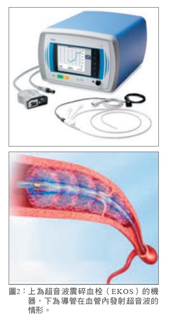 圖2：上為超音波震碎血栓（EKOS）的機 器，下為導管在血管內發射超音波的情形。