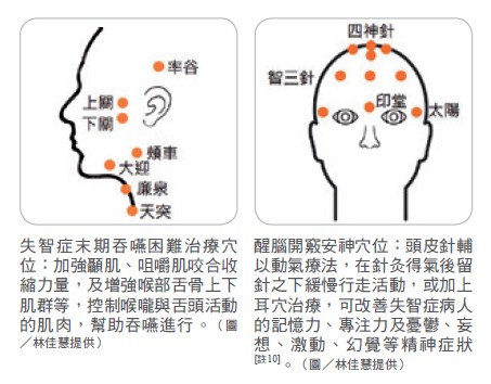 失智症末期吞嚥困難治療穴位