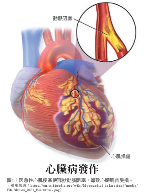 圖1：因急性心肌梗塞使冠狀動脈阻塞，導致心臟肌肉受損。
