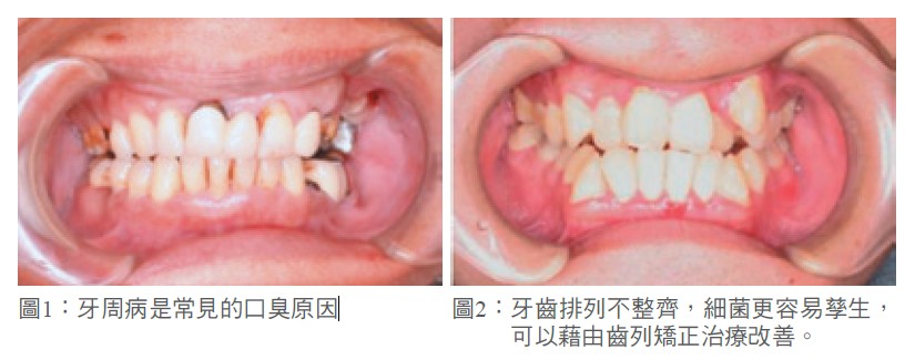 圖1：牙周病是常見的口臭原因