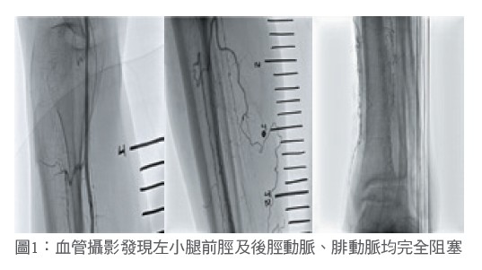 圖1：血管攝影發現左小腿前脛及後脛動脈、腓動脈均完全阻塞