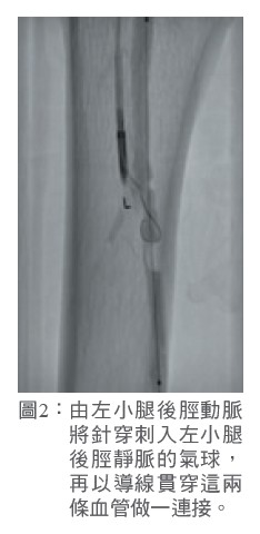 圖2： 由左小腿後脛動脈將針穿刺入左小腿後脛靜脈的氣球，再以導線貫穿這兩條血管做一連接。