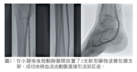 圖3： 在小腿後後脛動靜脈間放置了3支新型藥物塗層包膜支架，成功地將血流由動脈直接引流到足底。