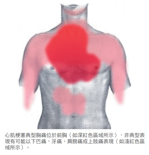 心肌梗塞典型胸痛位於前胸（如深紅色區域所示）