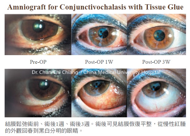 結膜鬆弛術前、術後1週、術後3週。術後可見結膜恢復平整，從慢性紅腫的外觀回春到黑白分明的眼睛。