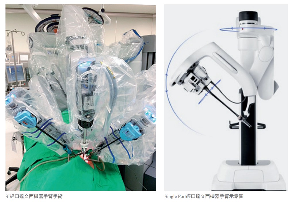 SI經口達文西機器手臂手術