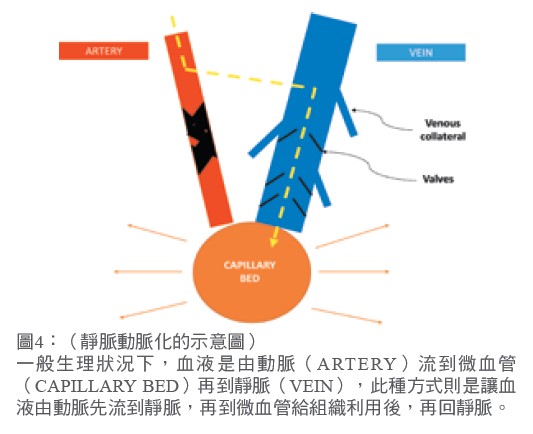 靜脈動脈化的示意圖