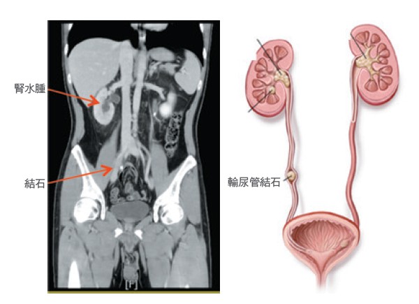 輸尿管結石