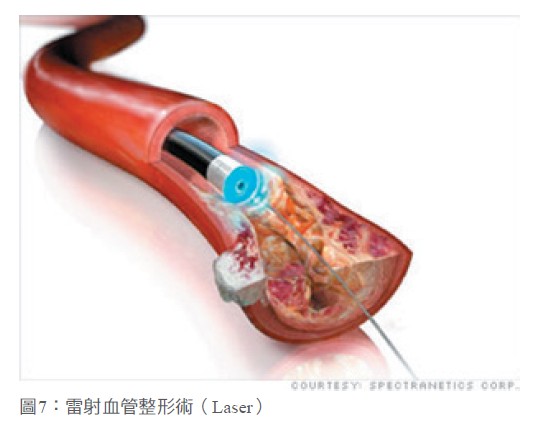 圖7：雷射血管整形術（Laser）