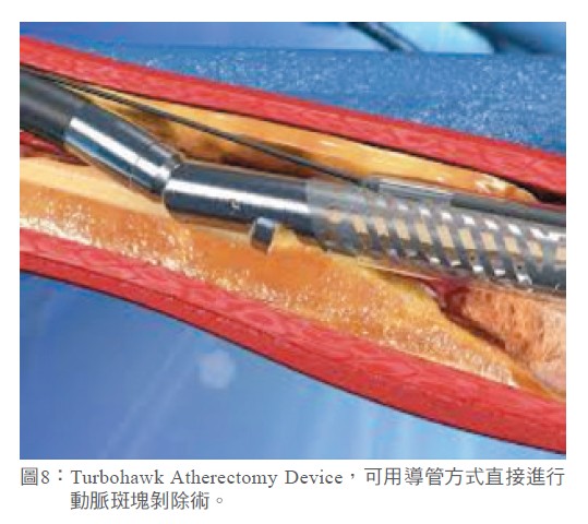 圖8： Turbohawk Atherectomy Device，可用導管方式直接進行動脈斑塊剝除術。