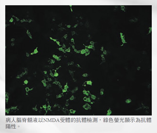 病人腦脊髓液以NMDA受體的抗體檢測，綠色螢光顯示為抗體陽性