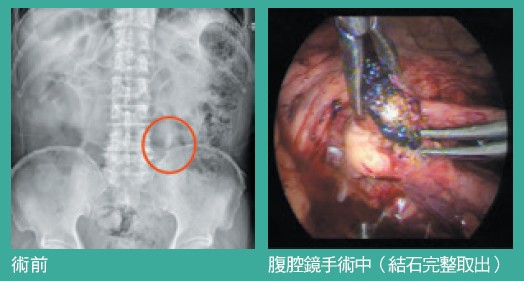 術前腹腔鏡手術中（結石完整取出）