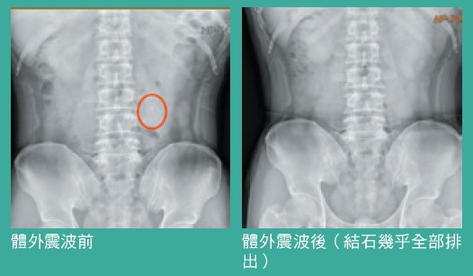 體外震波前體外震波後（結石幾乎全部排出）