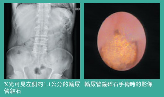 X光可見左側約1.1公分的輸尿輸尿管鏡碎石手術時的影像管結石