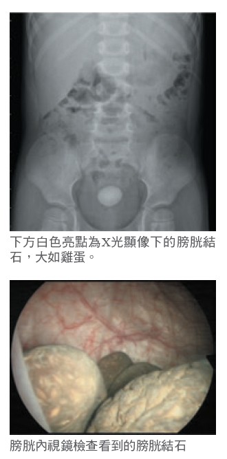 下方白色亮點為X光顯像下的膀胱結石，大如雞蛋。