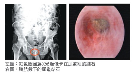 左圖：紅色圈圈為X光顯像卡在尿道裡的結石 