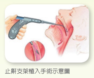 止鼾支架植入手術示意圖