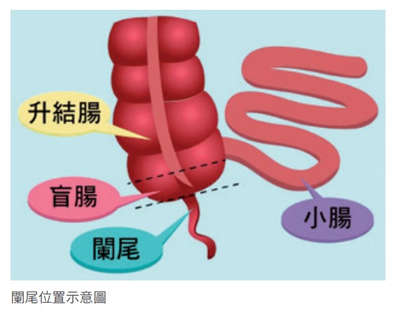 急性闌尾炎可能造成致命的腹膜炎 醫療新聞 中國醫藥大學附設醫院