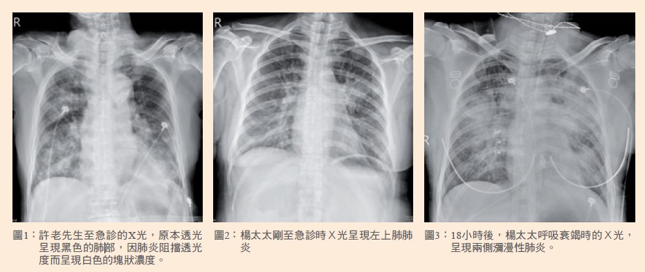 圖1： 許老先生至急診的X光，原本透光呈現黑色的肺部，因肺炎阻擋透光度而呈現白色的塊狀濃度。