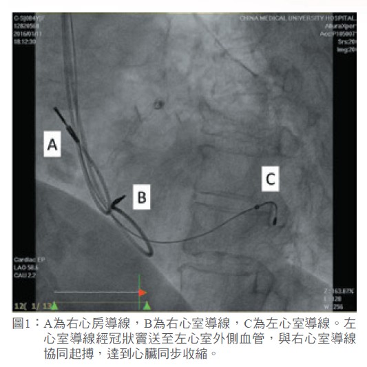 圖1： A為右心房導線，B為右心室導線，C為左心室導線