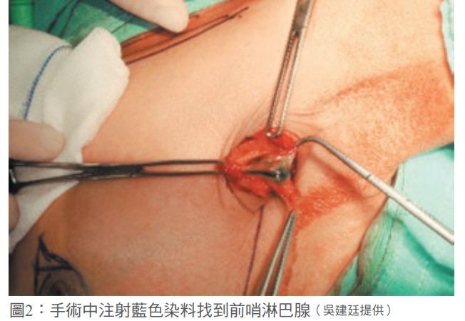 圖2：手術中注射藍色染料找到前哨淋巴腺（吳建廷提供）