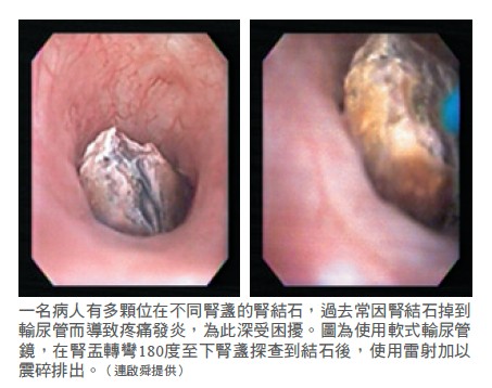 經皮穿腎取石手術的替代性治療