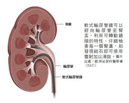 軟式輸尿管鏡雷射碎石術