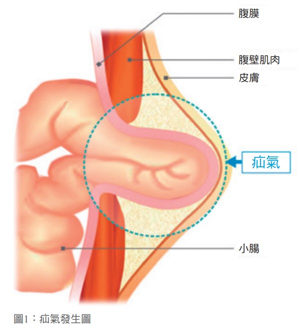 圖1：疝氣發生圖