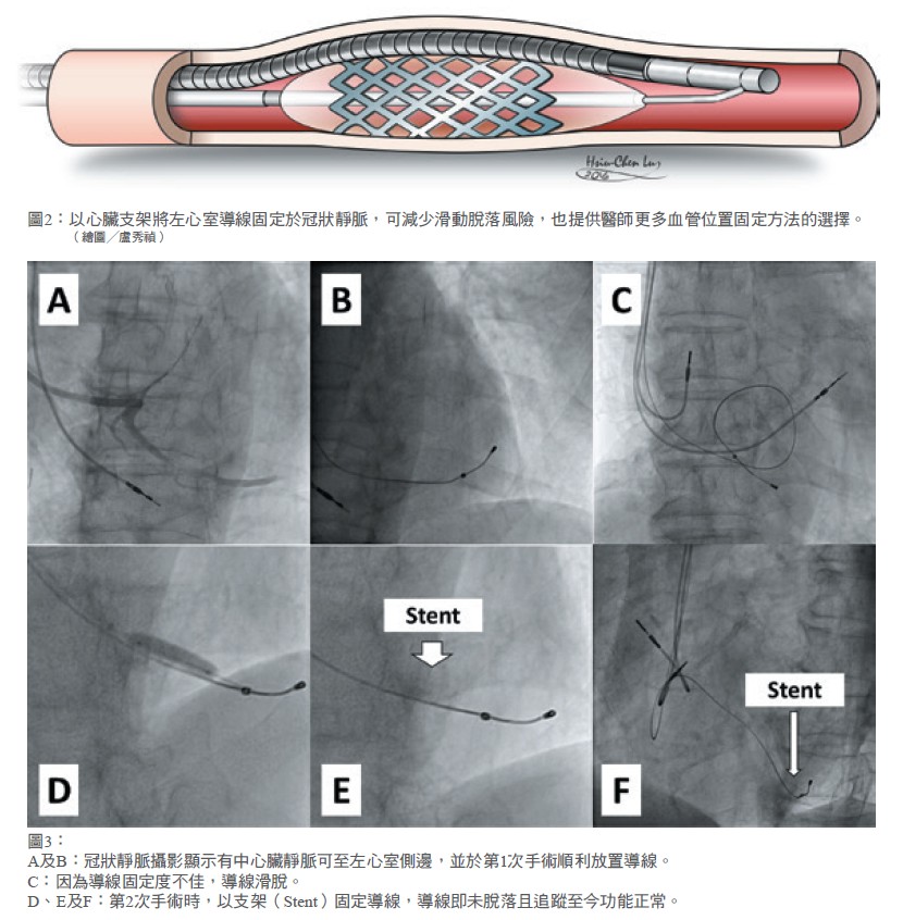 圖2： 以心臟支架將左心室導線固定於冠狀靜脈，可減少滑動脫落風險，也提供醫師更多血管位置固定方法的選擇。
