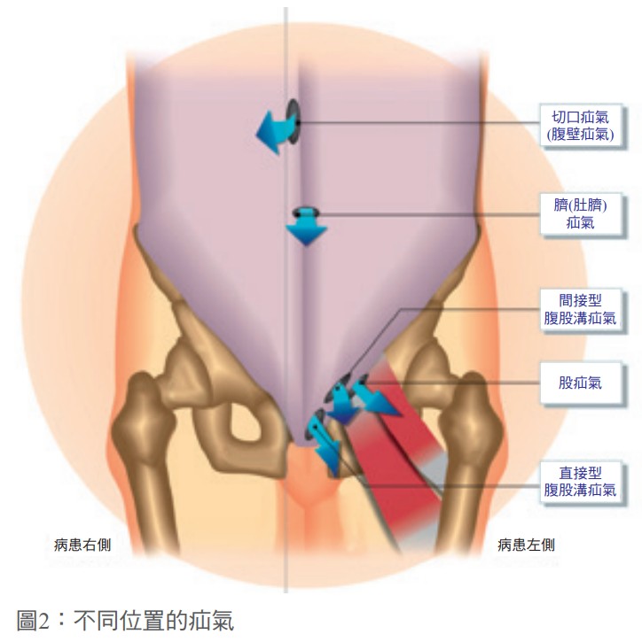 圖2：不同位置的疝氣