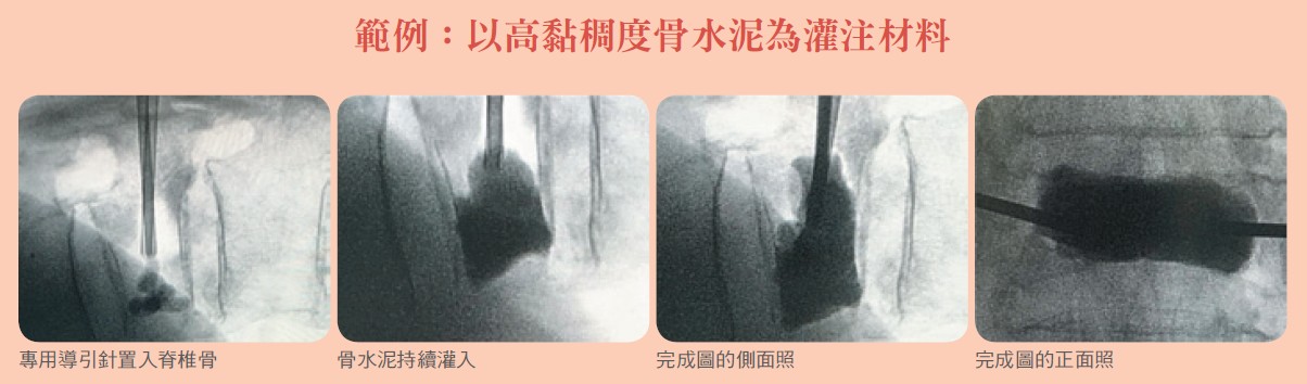 範例：以高黏稠度骨水泥為灌注材料