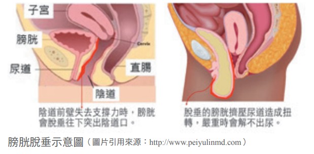 膀胱脫垂示意圖