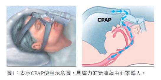 圖1：表示CPAP使用示意圖，具壓力的氣流藉由面罩導入。