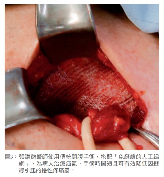 圖3： 張議徽醫師使用傳統開腹手術，搭配「免縫線的人工編網」