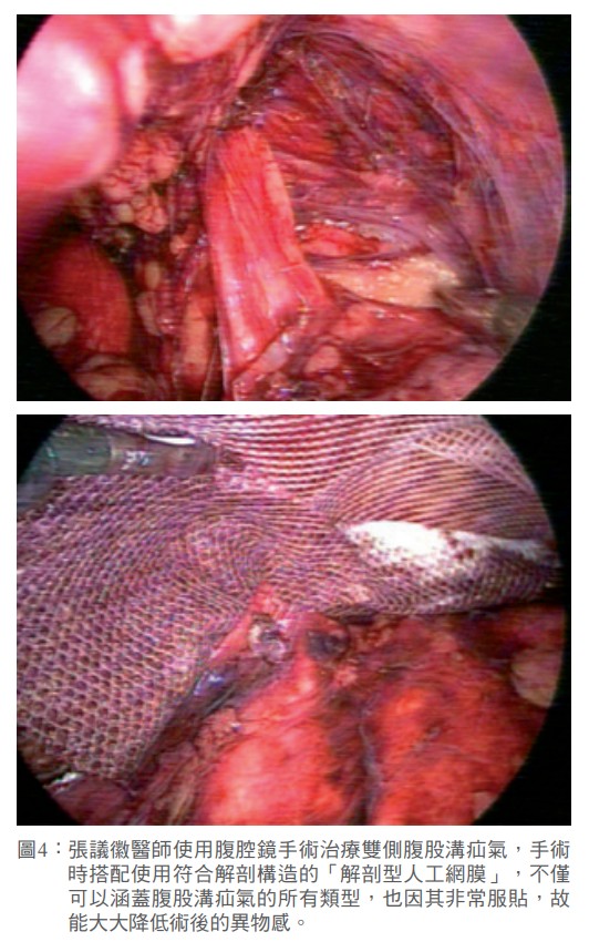 圖4： 張議徽醫師使用腹腔鏡手術治療雙側腹股溝疝氣