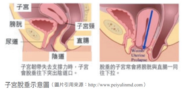 子宮脫垂示意圖