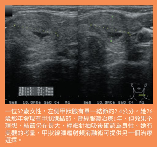 甲狀線腫瘤射頻消融術可提供另一個治療選擇