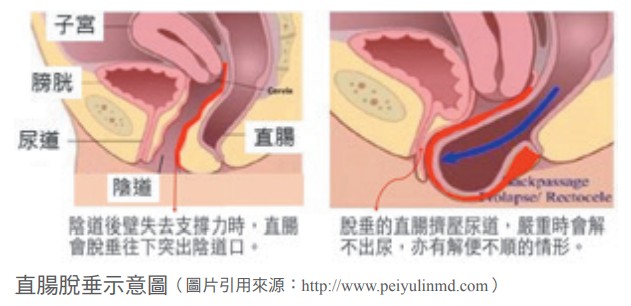 直腸脫垂示意圖