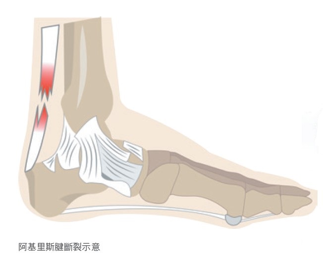 阿基里斯腱斷裂示意