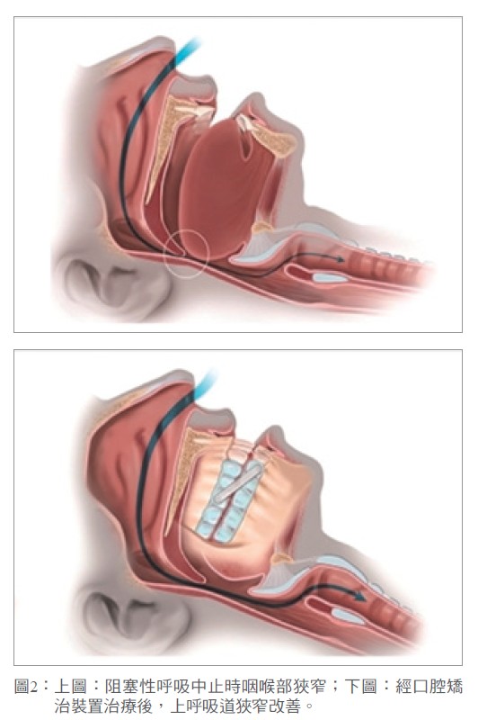 圖2： 上圖：阻塞性呼吸中止時咽喉部狹窄