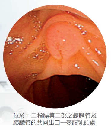 位於十二指腸第二部之總膽管及胰臟管的共同出口—壺腹乳頭處