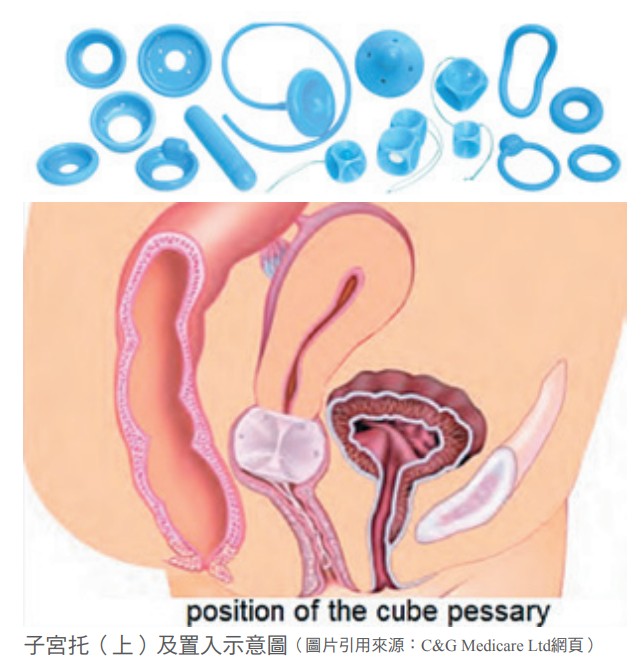 子宮托（上）及置入示意圖