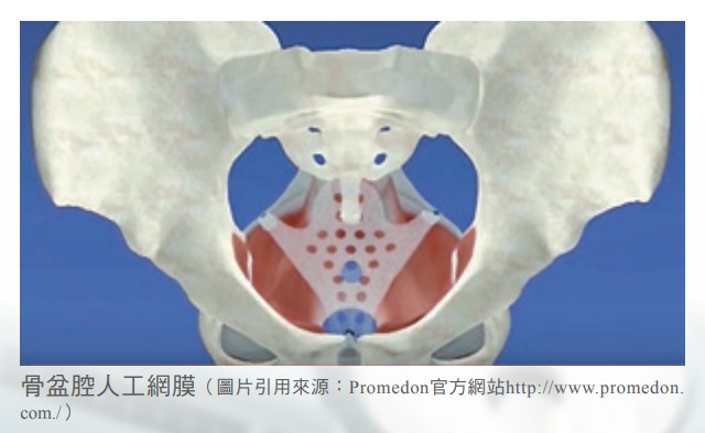 再也hold不住了 女性骨盆腔器官的墜落 中亞健康網 用心傳遞每一刻為您把關健康人生