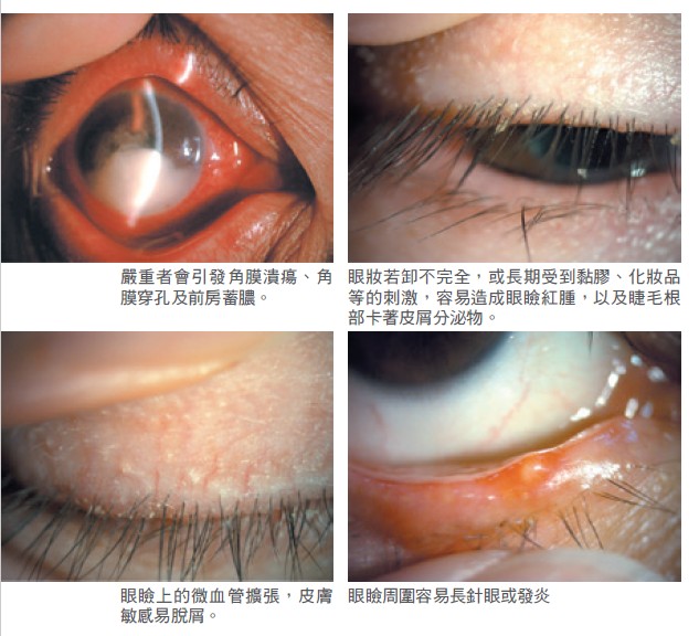 嚴重者會引發角膜潰瘍、角膜穿孔及前房蓄膿。