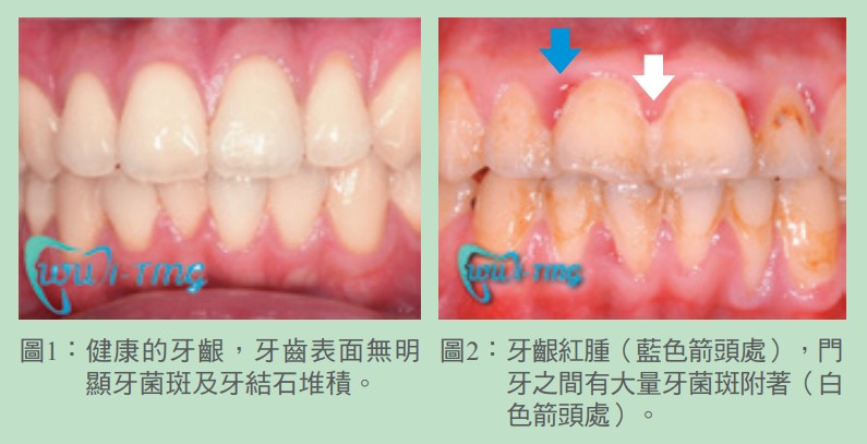 圖1：健康的牙齦，牙齒表面無明顯牙菌斑及牙結石堆積。